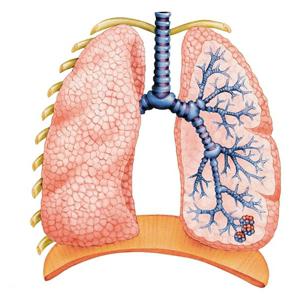 Chronisch obstruktive Lungenerkrankung - eine Bedrohung für das Leben von Tabakkonsumenten